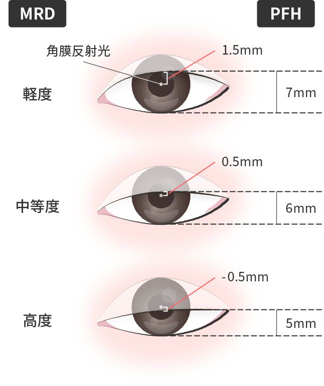 眼瞼下垂の程度評価